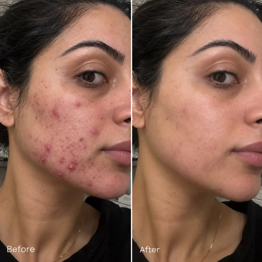 Before and after chin blemish and texture skincare result