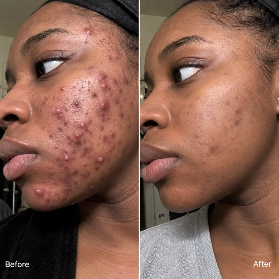 Before and after cheek pore texture skincare result