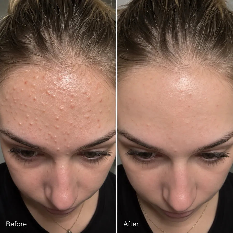 Before and after nose and cheek pore skincare result