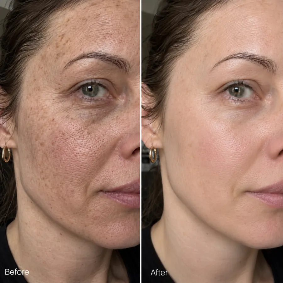 Before and after cheek blemish and skin texture skincare result