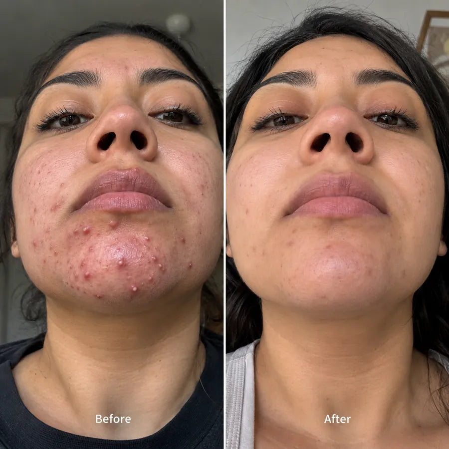 Before and after forehead texture skincare result