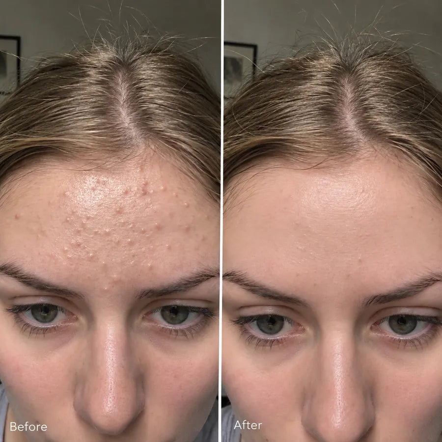 Before and after nose pore skincare result