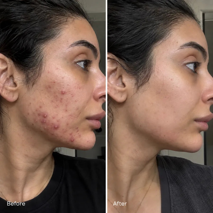 Before and after acne-prone cheek skincare result