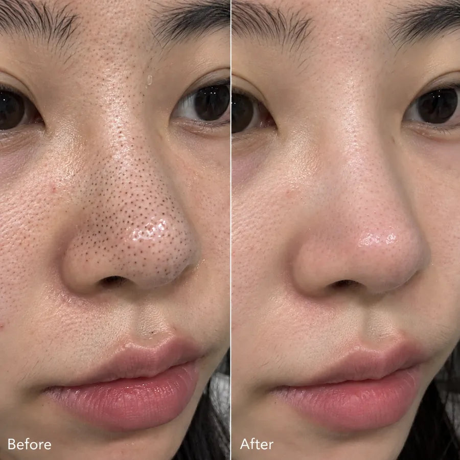 Before and after nose blackhead skincare result