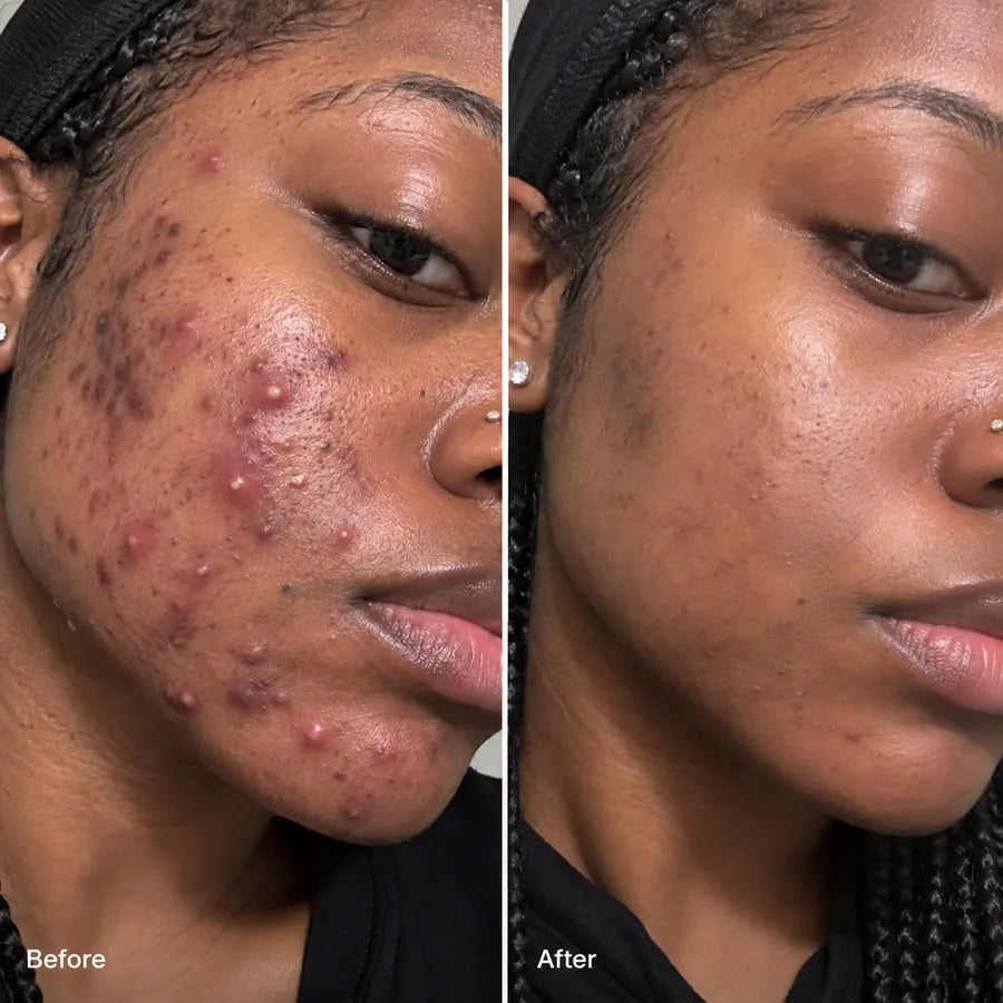 Before and after acne-prone cheek skincare result