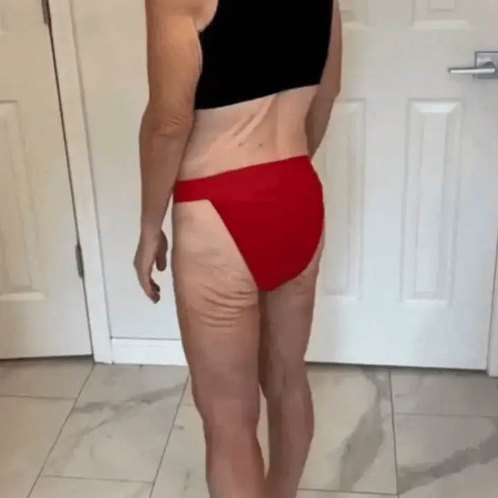 Visible skin texture concerns on the buttocks